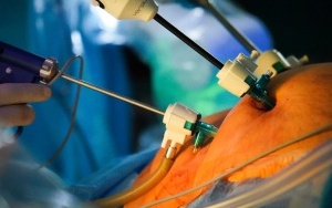 Operacja przy użyciu robota VERSIUS w UCK SUM w Katowicach (5)