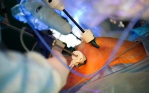 Operacja przy użyciu robota VERSIUS w UCK SUM w Katowicach (6)