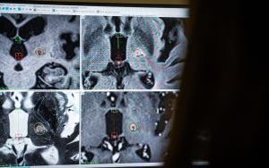 Exira Gamma Knife w Katowicach